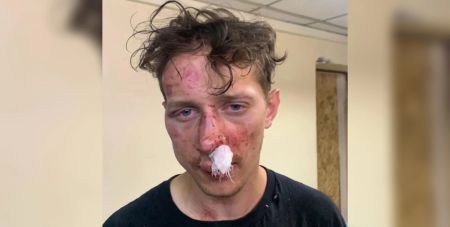 Ексвійськового побили через зачіску в Києві: нападників відпустили (фото)