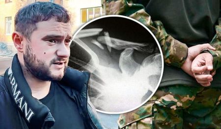 Житомирський адвокат заявив, що йому зламали ключицю через мобілізацію: деталі інциденту