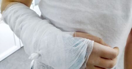 Дослідники створили кістковий “суперклей”, який за лічені хвилини зрощує переломи