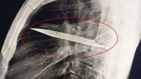 Чоловік 8 років жив з ножем у грудях і не знав про це (ФОТО)