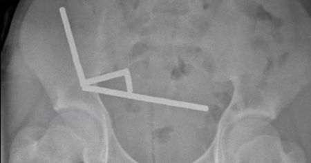 Хлопчик з’їв 200 магнітів — операція ледь не закінчилась трагедією