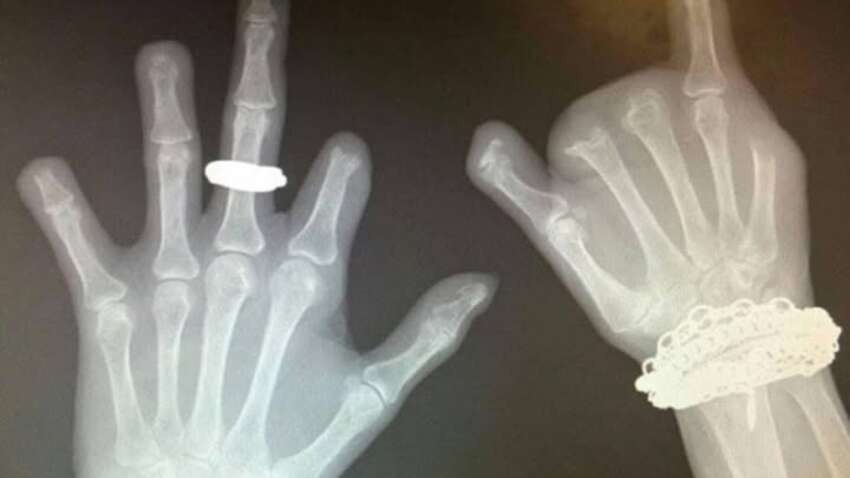 Звичка, яка може закінчитися ампутацією: медики показали шокуючий клінічний випадок