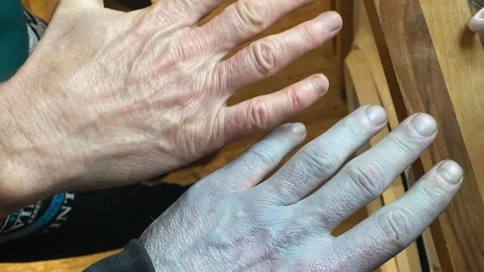 Синя шкіра та термінова госпіталізація: як нова постіль ледь не довела британця до відчаю